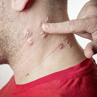 Causes, symptoms and treatment of Shingles